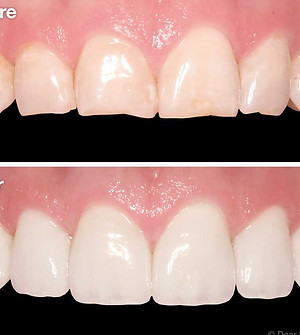 Veneers 3.jpg