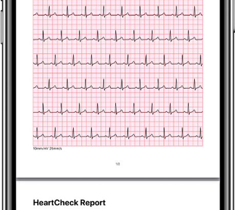 smartphone ecg.png