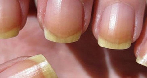 Como blanquear la uñas amarillas por el esmalte.