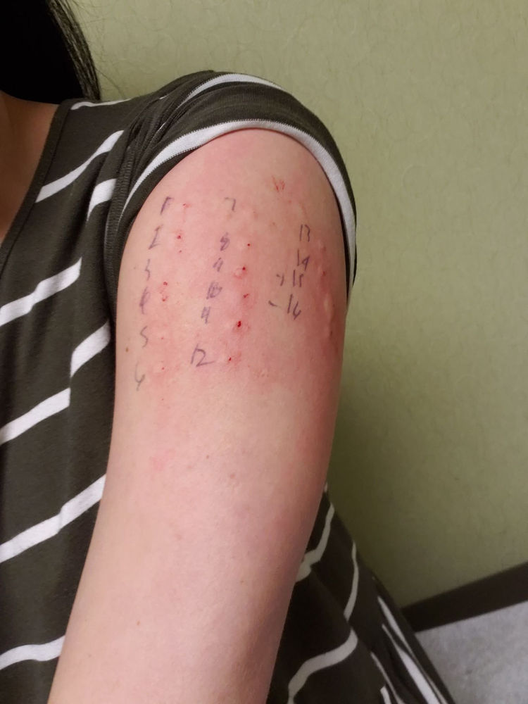 Allergy Testing - I'm Allergic to Everything