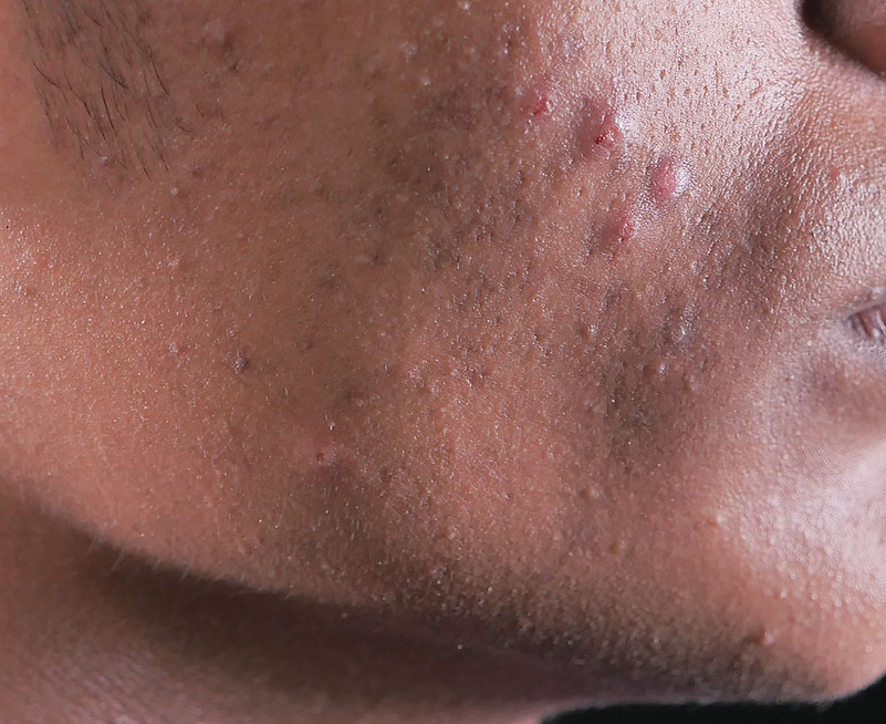 Dark skin acne blemish.jpg