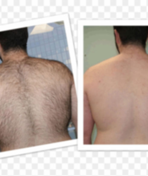 Back Hair removal.png