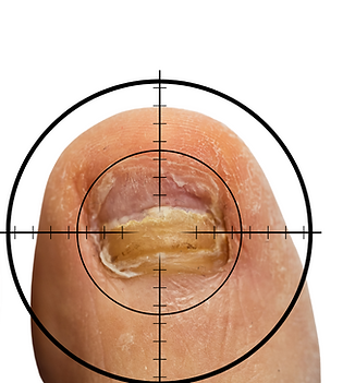 Fungal nail laser treatment that works Folkestone Kent