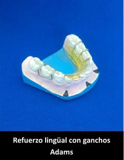 Refuerzo lingual con ganchos Adams