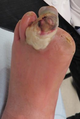 Infected toe ulcer.jpg