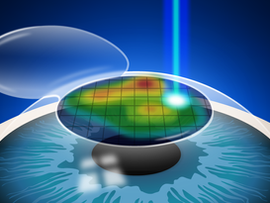 Posso usar óculos ou lentes após a cirurgia de correção da miopia?