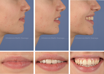 CONTROL VERTICAL CON MICROTORNILLOS PARA EL TRATAMIENTO DE LA MORDIDA ABIERTA ANTERIOR