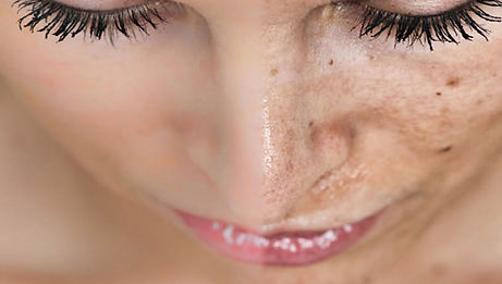 dermapen.jpg