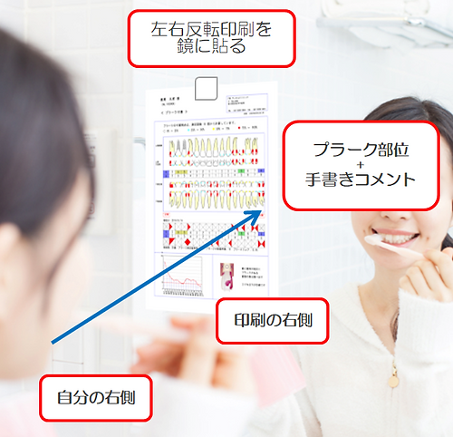 プラークチャート反転印刷を鏡にはりセルフケア.PNG