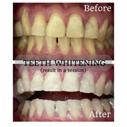 Eurolab Aesthetic Teeth Whitening Before and After