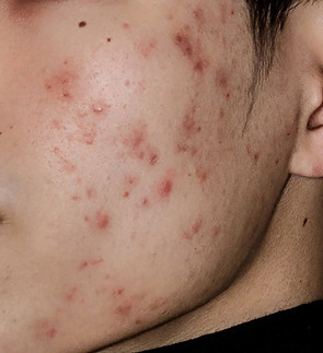 Acne and marks 2.jpeg