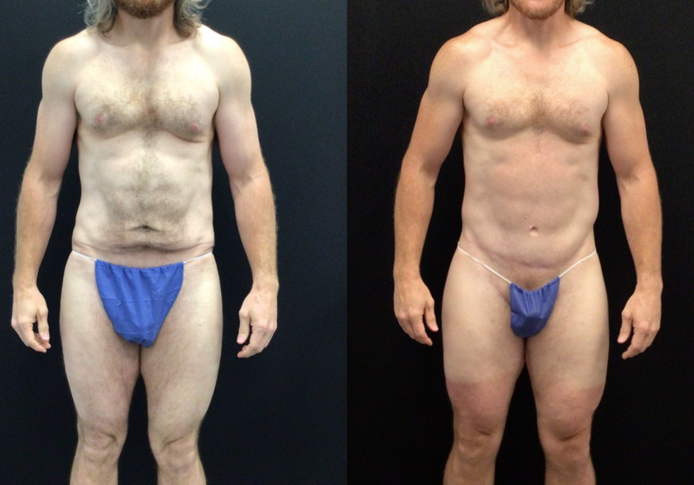 Before and After Body Lift and Thigh Lift
