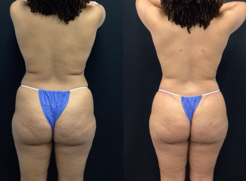 Extended Tummy Tuck Before and After with Buttock Lift