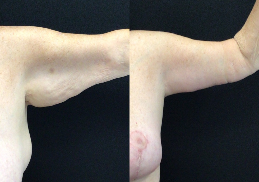Brachioplasty Before and After