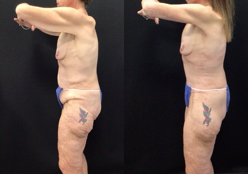 Before and After Brachioplasty