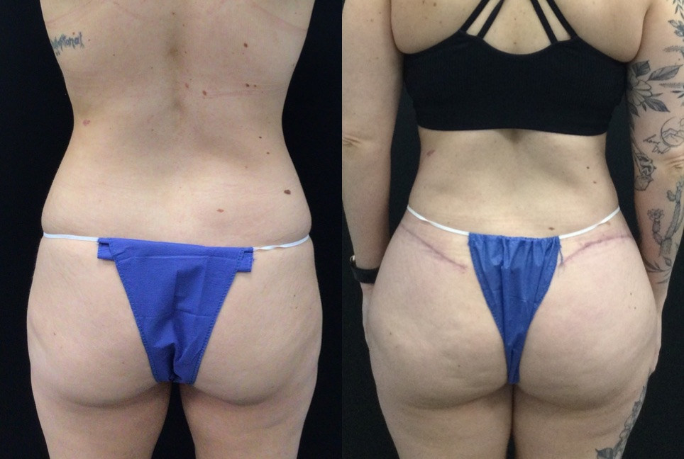 Long Term Scar Healing Extended Tummy Tuck