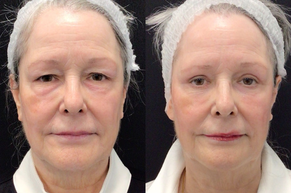 Before and After Lower Blepharoplasty