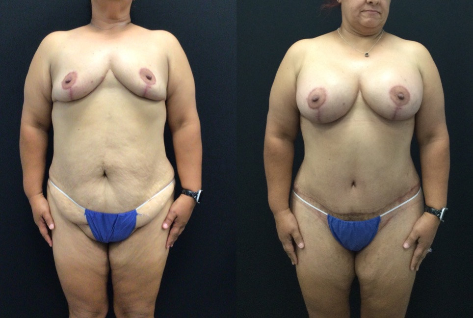 Before and After 2 stage Breast Reduction and Augmentation and Lower Body Lift. 