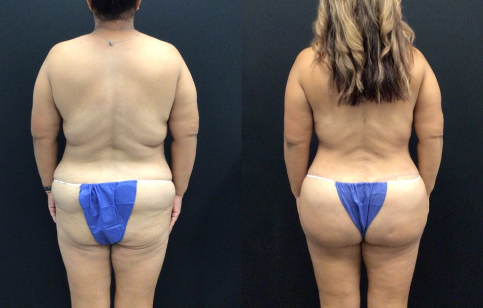 Buttock Lift and Fat Grafting to Buttocks (BBL)