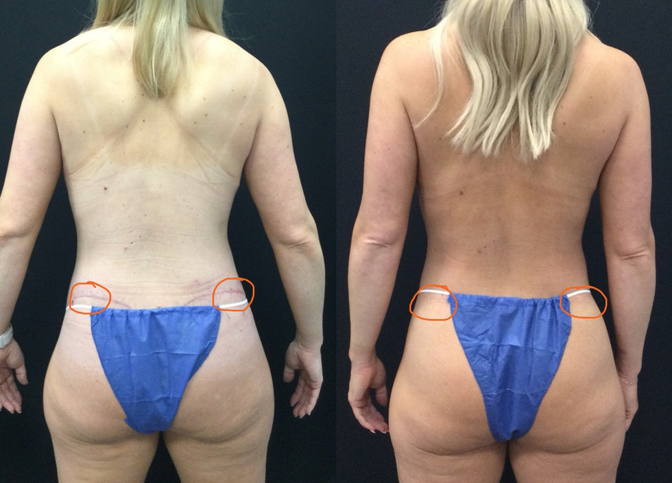 Long Term Scar Healing Extended Tummy Tuck