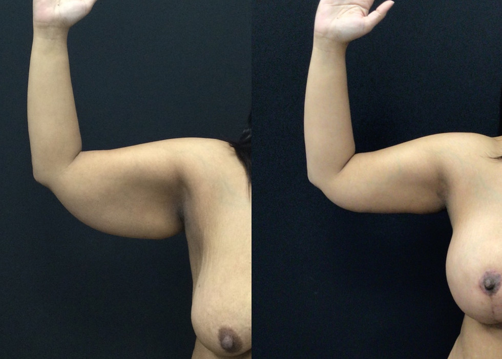 Brachioplasty and Augmentation Mastopexy