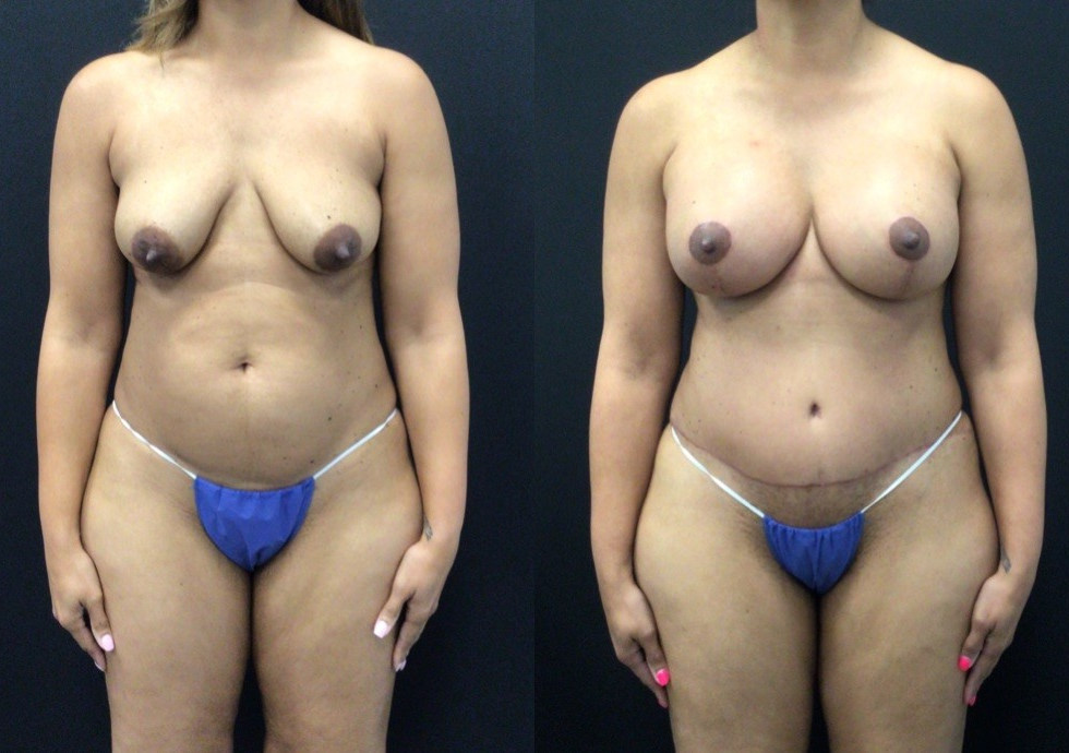 Before and After Mommy Makeover