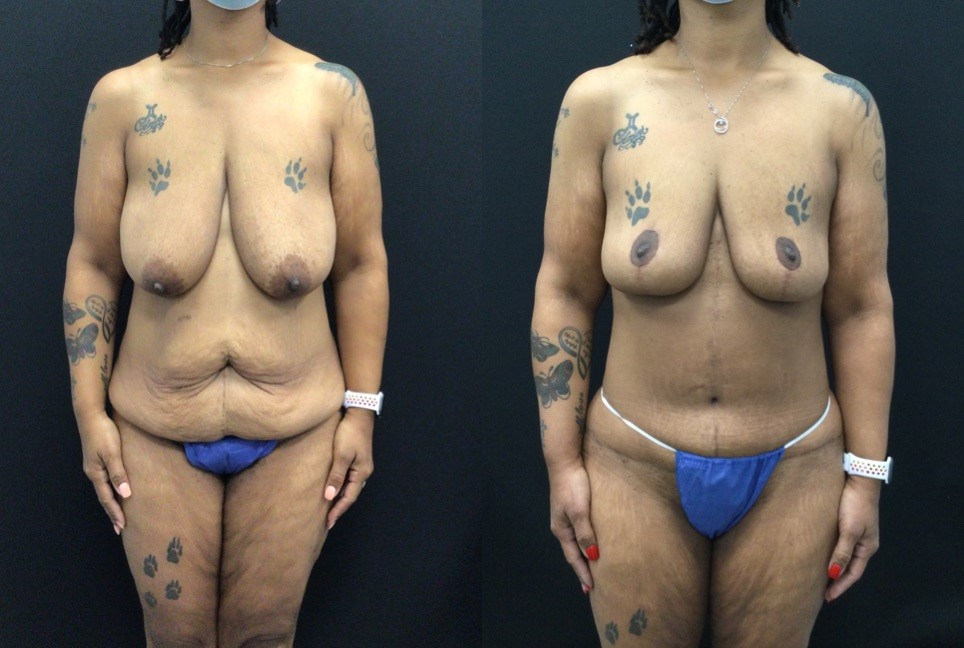 Before and After Breast Lift and Fleur Des Lis Abdominoplasty