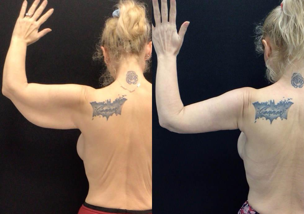 Before and After Brachioplasty, Implant Exchange, and Inferior Wedge Mastopexy