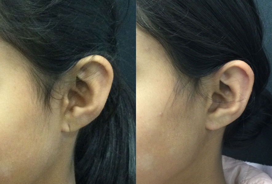 Reparación de aretes