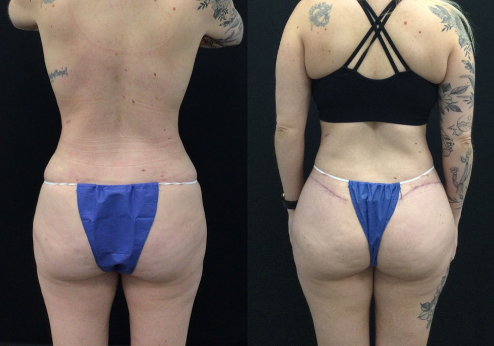 Contorno de glúteos después de una abdominoplastia extendida