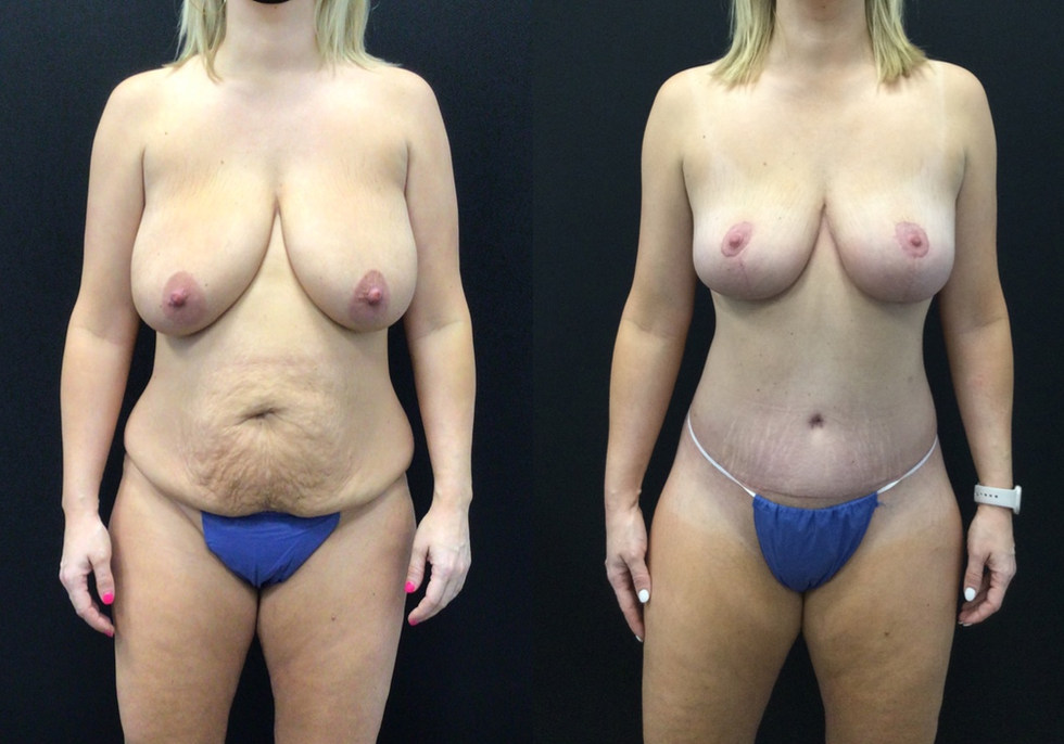 Before and After Body Lift