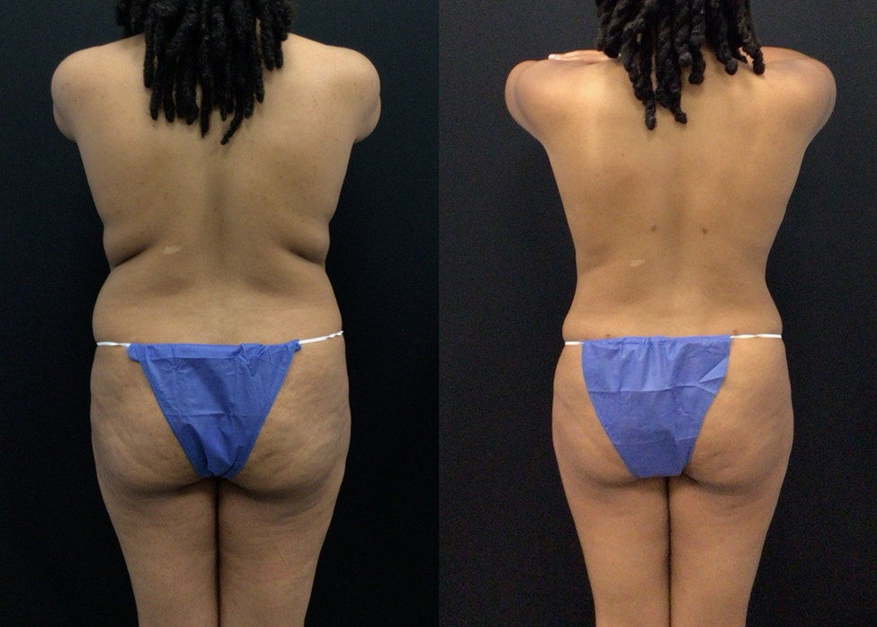 Before and After Lipo 360 and Body Tite to Upper back skin folds