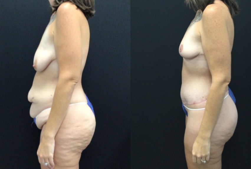Before and After Body Lift and Breast Lift