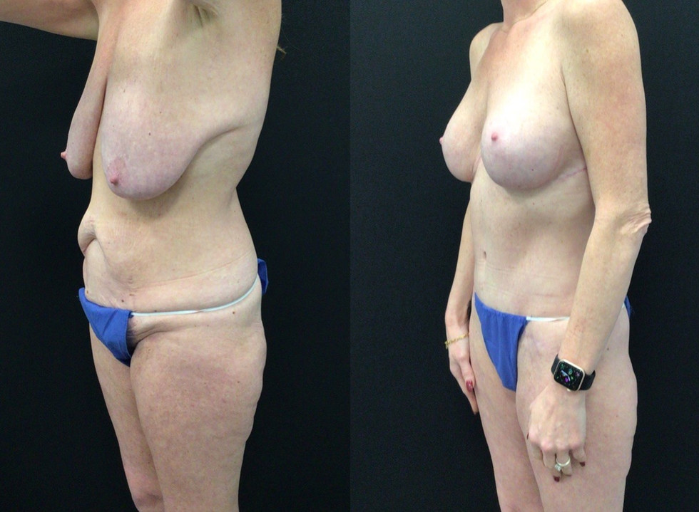 Second Stage Breast Augmentation following initial Breast Lift and Tummy Tuck Following Weight Loss Surgery