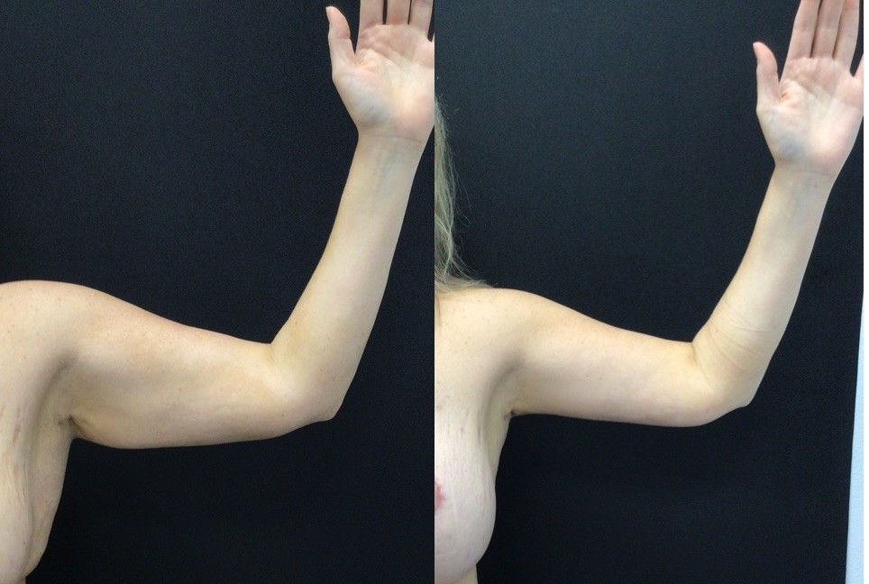 Brachioplasty Before and After