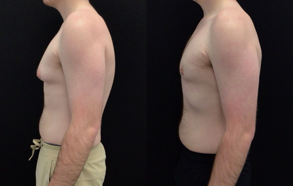 Before and After Male Breast Reduction