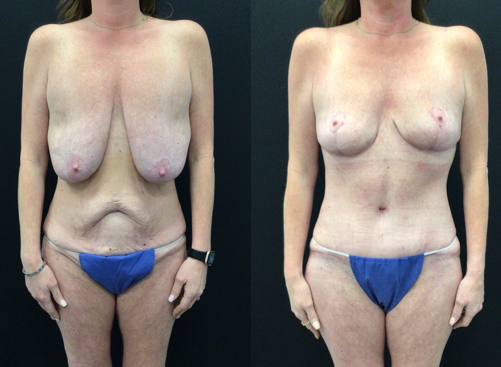 Breast Lift and Tummy Tuck Following Weight Loss Surgery
