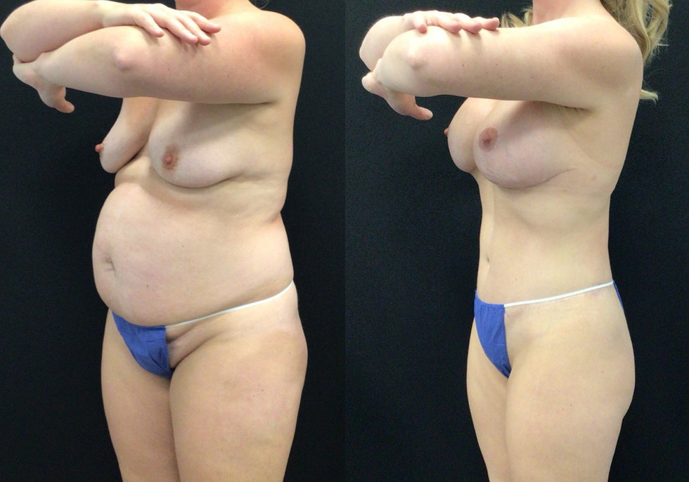 Long Term results; Before and After Extended Abdominoplasty, Breast Lift with Implants, and Lipo 360