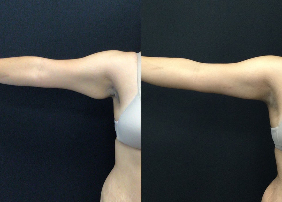 Brachioplasty Before and After