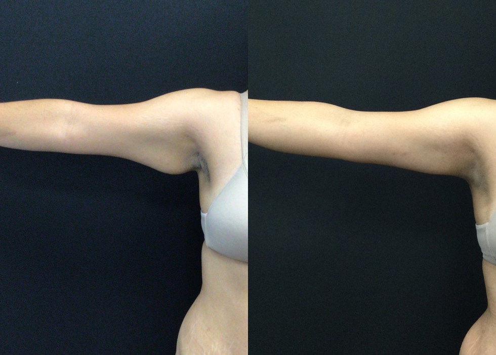 Brachioplasty Before and After