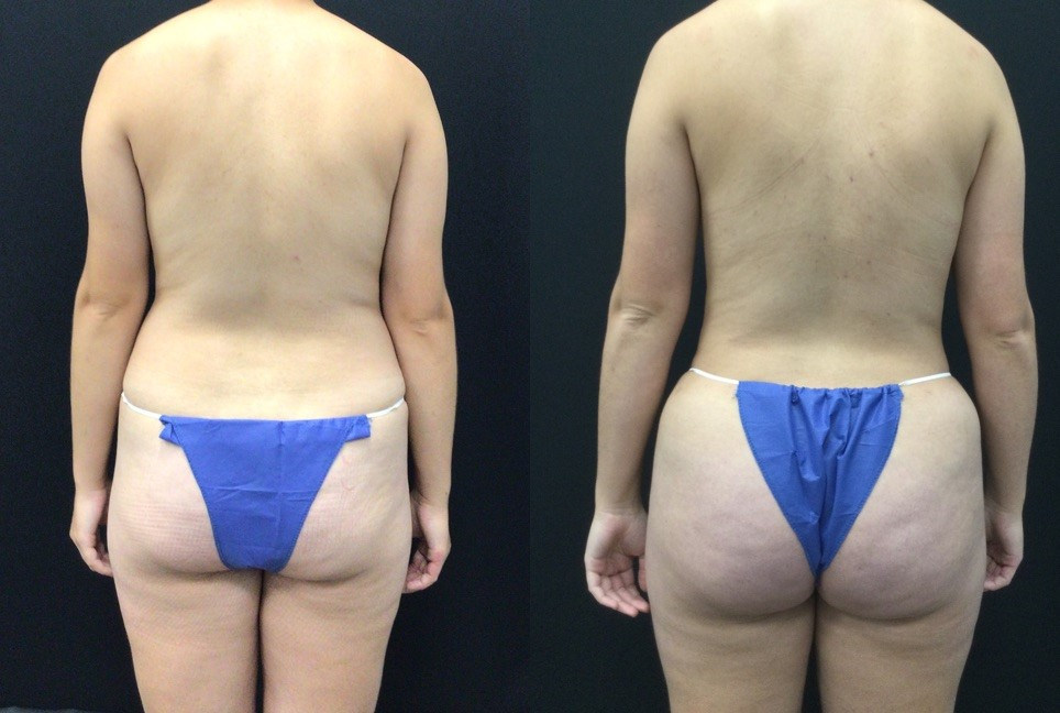 6 weeks post op from Left Breast Augmentation, Right Breast Lift with Augmentation, 360 Liposuction, and Fat Grafting to Buttocks (BBL). 