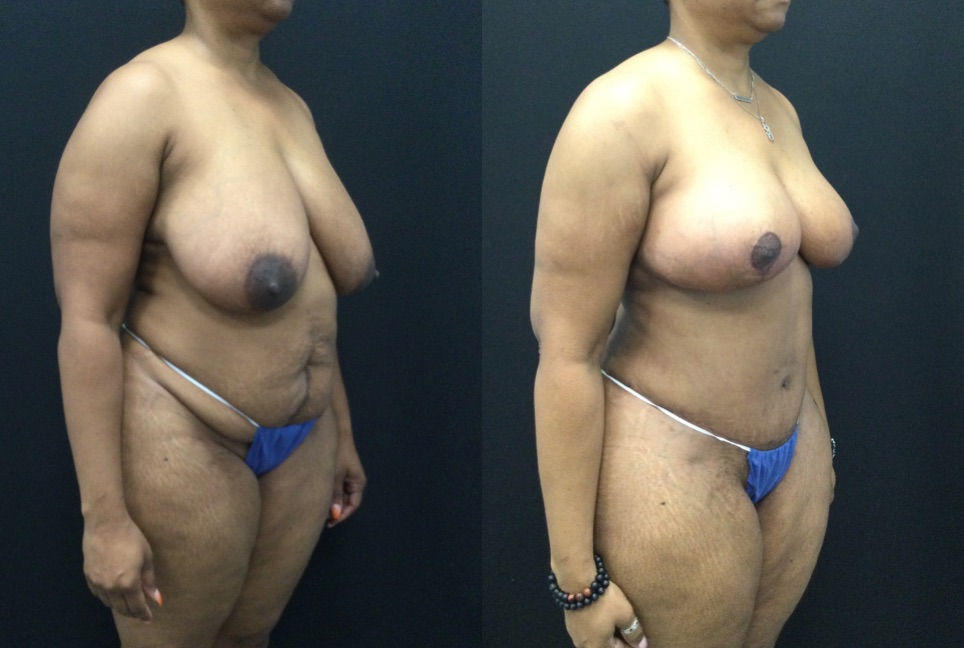 Antes y después de la abdominoplastia