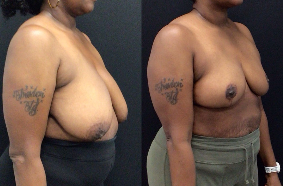 Before and After Breast Reduction