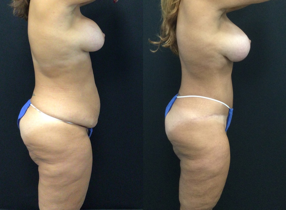 Before and After Mommy Makeover