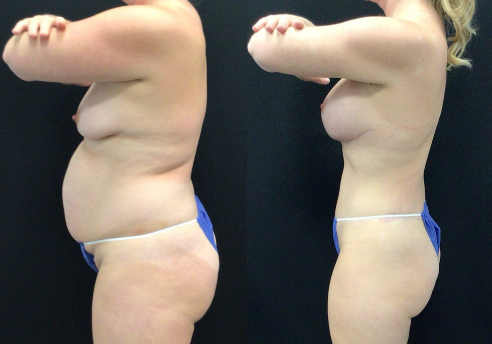 Long Term results; Before and After Extended Abdominoplasty, Breast Lift with Implants, and Lipo 360