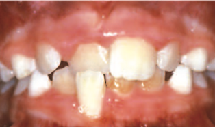 Anterior Crossbite
