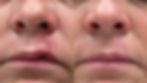 Scar removal on the upper lip