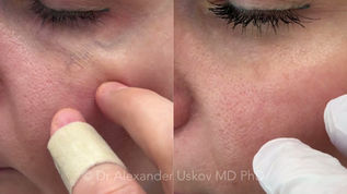 Video silmaümbruse veeni eemaldamise protseduurist. Demonstreeritakse silmade ümbruse tundliku piirkonna veresoonte struktuuride õrna laserravi.