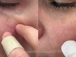 A video of a periorbital vein removal procedure. Delicate laser treatment of the vascular structures in the sensitive area around the eyes is demonstrated.