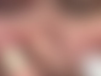 A video of a periorbital vein removal procedure. Delicate laser treatment of the vascular structures in the sensitive area around the eyes is demonstrated.